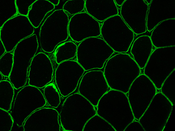 muscle-cs-2 Neuromuscular Disease Treatment Today